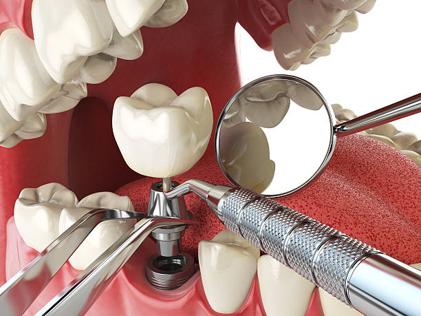 Best Emergency Broken Tooth Repair in Coral Terrace, FL